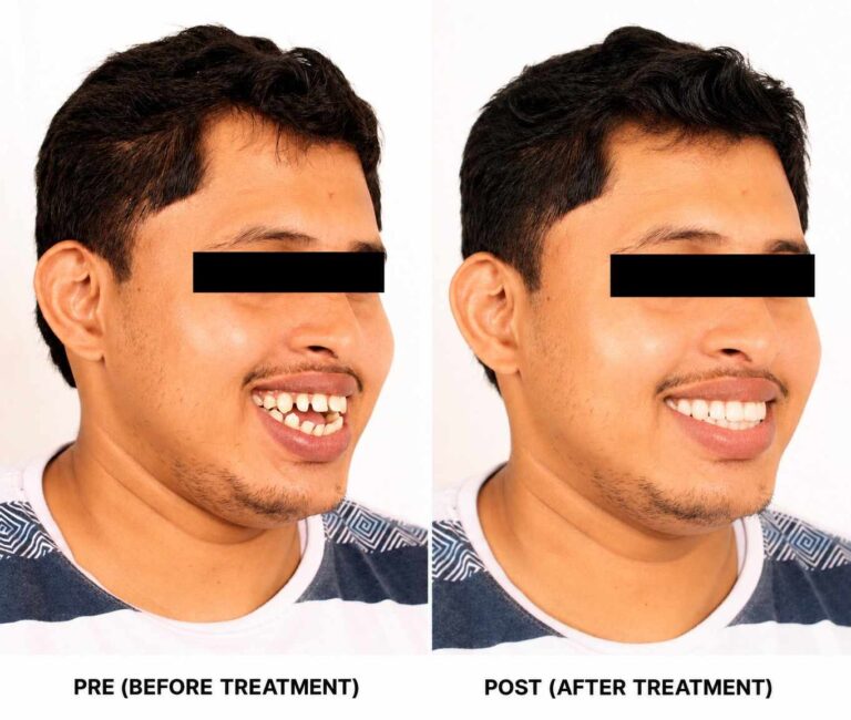 From Misaligned to Confident Smile
