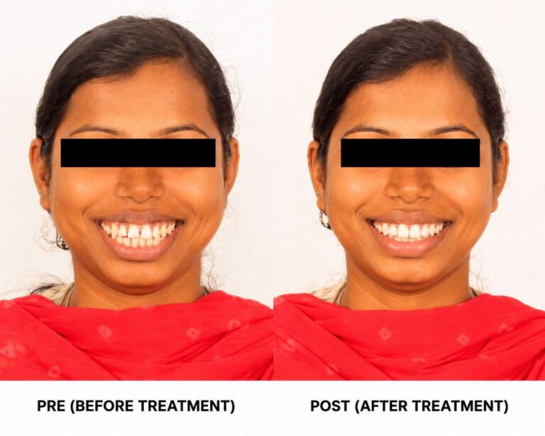 Orthodontic Smile Transformation